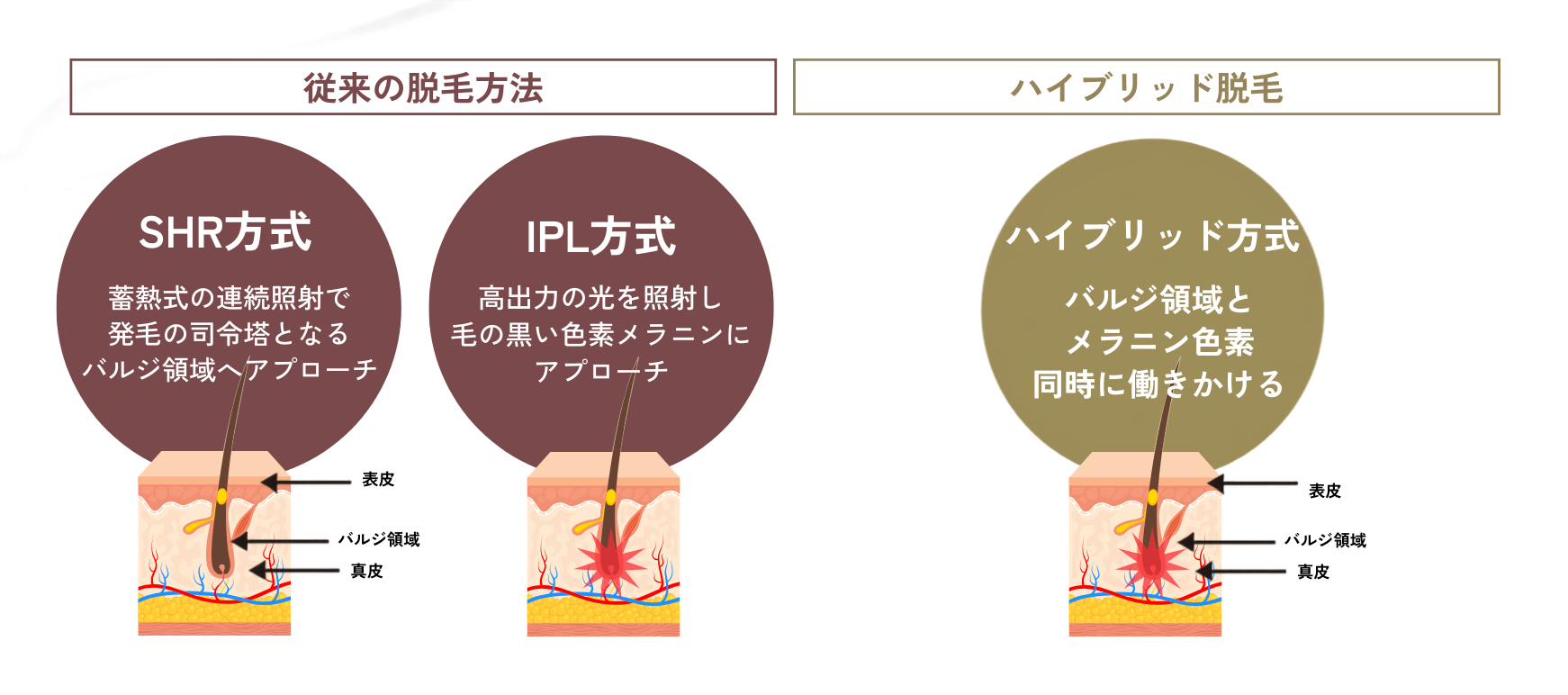 ハイブリッド脱毛とは